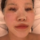 용산-167 | 용산 웨딩관리 온플릭 에스테틱 추천, 턱선 살아나는 디자인 페이스핏 리프팅 후기