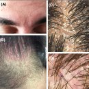 루빈여성의원 | 최신 연구로 풀어보는 지루성 두피염, 뉴헤어부산의원.