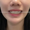 미소담은치과의원 | 안면비대칭 교정 후기 가격, 부정교합 + 턱관절 비대칭 +좁은악궁 케이스