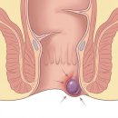 자연치유37도(주) | 외치질 자연치료 기간 방치하다 3개월 만에 악화된 실제 경험담