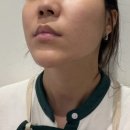 청담피부과 팔자 볼륨 부스터 미희 주사 후기