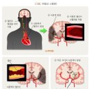 [간편]뇌혈관질환 진단비(1년50%) 특별약관 이미지