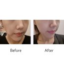 크라이오셀(Cryocell) | 크라이오셀 후기,피부 진정,붓기 홍조고민 30대 내돈내산리뷰 이미지관리