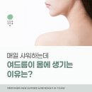 약초와 생활한방 | 범계등여드름피부과에서 알려드리는 등 부위 트러블 관리법 약초침