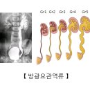 선천성 수신증[Congenital hydronephrosis] 소아청소년질환, 신장비뇨기질환, 유전질환 이미지