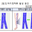 ‘하지정맥류’란[초음파 검사를 통해 0.5초 이상의 혈액의 역류가 확인되는 경우 하지정맥류로 진단] 이미지