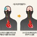 뇌졸중 이미지