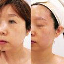 케이엠(주) | 마곡웨딩관리로 많이 찾는 케이엠에스테틱, 성형윤곽관리 1회 후기