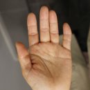 춘천습진 치료 잘하는곳 찾기 전 알아야 할 한의원 관리법