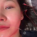 서울숲5 | 서울숲 안면비대칭 교정 후기, 5회차 눈 광대 턱 비대칭 개선 전후