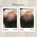 더비채 | 가산 탈모관리, 비채두피탈모센터 관리 받은 후기