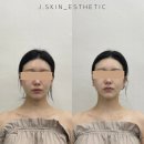 제이메디칼 | 대구 데콜테관리 동성로 작은얼굴 전문 제이스킨 후기