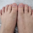 레푸스 망우점 | [중랑구내성발톱]레푸스망우점-내성발톱교정후기