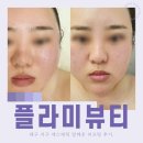 톡톡튀는뷰티 | 대구 서구 에스테틱 플라미뷰티 알테온 리프팅 관리 후기