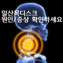 일산목디스크원인/증상 확인하세요! 이미지