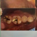 벚꽃치과의원 | 구로) 과잉진료없는 인레이치료후기 구로치과 비타민치과