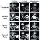 Preoperative Differential Diagnosis of Canine Adrenal Tumors Using CT 이미지