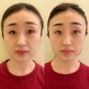 못골로04 | 못골윤곽관리 보혜뷰티 브이윤곽테라피 비포 애프터 후기