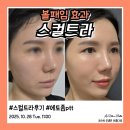 알렉스 | 신사역피부과 팔자 볼패임 스컬트라 효과 후기, 에토좀ptt + 알렉스 토닝