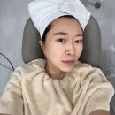 헬리오스 | 청담피부과 기미 잡티제거 토닝레이저 색소레이저 헬리오스785후기
