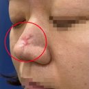 로이성형외과의원 | [코수술흉터 치료 경과] DNA 진피재생술 (feat 수면마취) 성형수술 괴사 흉터, 부작용 치료