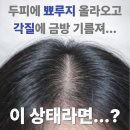 i피부샾 | 지루성두피 샴푸 추천 | 탈모·각질·두피 뾰루지까지 해결된 후기 (블랙포레 루트파워 쿨&딥클린)