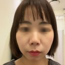 청담한의원 | 청담동한의원 안면비대칭 청담한의원 턱관절 얼굴 비대칭 교정 후기 (전후사진 있음)