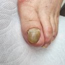 하모니마트 과천점 | 관악역발톱무좀 뽑지 않고 안아프게 해결한 곳 포쉬네일 동성제약 풀리메디 금천점