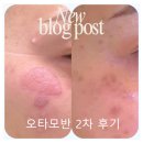 더라움의원 | [2탄] 압구정 라움성형외과 오타모반 제거 /특급정보o/가격공유/시술후기(2)