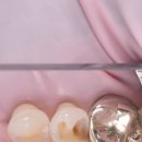 울산플러스치과의원 | [공지] 울산 스마일플러스치과 레진빌드업 치료란?