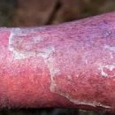 쉽고 빠른 생활 응급처치 가이드 | 군화 탓? 훈련 중 **봉와직염** 초기 증상과 생존을 위한 **응급처치** 가이드