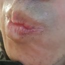 (주)호남엔도케어 | [부산 이좋은45치과_ 못골역 2번출구] 부산 임플란트 치료를 위한 크라운치료_멀쩡한 치아 상거상술...