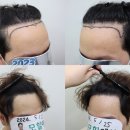 압구정개성시대 | 측면(엠자)부위를 둥글게 디자인하면 여성형라인인가요?