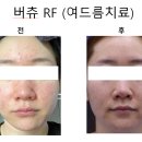 톡스앤필의원불당점 네이버블로그