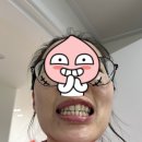 세라믹치과기공소 | 앞니 4개 루미네이트 시술 후기! 가격, 장단점 &amp; 시술전 시술후 비교사진