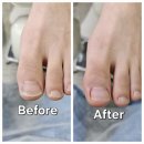 레푸스 | 노원 내성발톱 관리 만족후기 레푸스