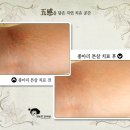 다이어트 후 튼살 치료 방법 이미지