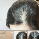 강서구-30 | 강서구 탈모케어, 30대 여성 가르마 탈모 알알 케어 후기 ( 15회차 )