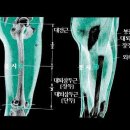 뇌혈전(뇌경색)-- 한의학공부는 정규대학교로 입학해야 합니다. www.scukorea.com 이미지