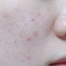 한결약국 | 약국 재생크림 흔적관리 바르는법 추천 후기