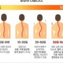 척추측만증 원인,증상,예방,치료 - 척추측만증 교정 운동 이미지