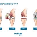 무릎인공관절수술, 최소절개술로 !| ·‥‥‥ 이미지