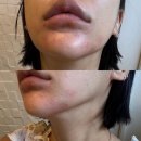 진정슈퍼 | 일본 여행 추천템｜더마 레이저 슈퍼 VC100 & 엑소좀100 마스크팩 후기, 피부 진정 효과 만족