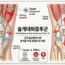 장경개발 | 러닝 중 무릎 통증 왜 생길까? 직접 고친 후기와 찐 러너들의 관리 방법 총정리