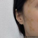 능곡의원 | 일산 능곡 예인의원 편평사마귀 비립종 점 얼굴 무제한 제거 후기