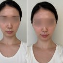 심피부과의원 | 강남구청피부과 [쥬베룩볼륨 & 루블름] 관자놀이 후기 내돈내산