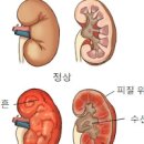 만성 급성 신우신염 증상 원인 치료 이미지