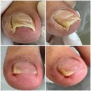 올패랑 | 포항 송도 내성발톱 패디파인 베어플레티넘 포항장량점에서 관리받은 후기