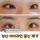 스타타워2차 | 부산아이라인 문신 제거 1회차 후기(feat. 주근깨 제거)