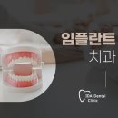 이천임플란트치과 잘 고르고 비용 줄이는 방법